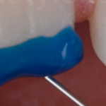 Клинический случай восстановления скола коронки зуба 1.1 текучим композитным материалом: реставрация без пузырьков