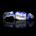 Повторная реставрация боковых зубов по CAD/CAM технологии