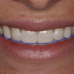 Определение позиции режущего края верхних зубов при помощи дентальной фотографии