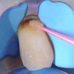 Пришеечная реставрация зуба
