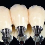 Временные CAD/CAM реставрации и цифровой подход к стоматологической реабилитации