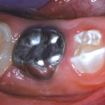 Пульпотомия временных зубов ЦОЭ и MTA: потенциально менее токсичная альтернатива формокрезолу