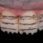 Оптимизация реставрации передних окрашенных зубов с помощью керамических виниров