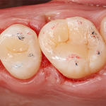 Воссоздание контактных пунктов в случаях ротации нескольких зубов